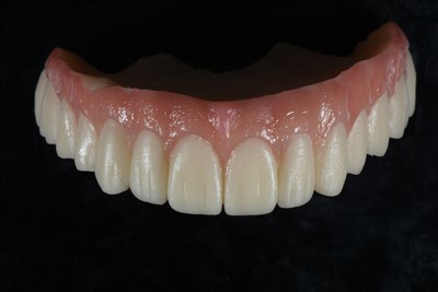 Corona provvisoria in resina acrilica