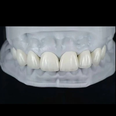 Faccette E.max per chiusura di diastema
