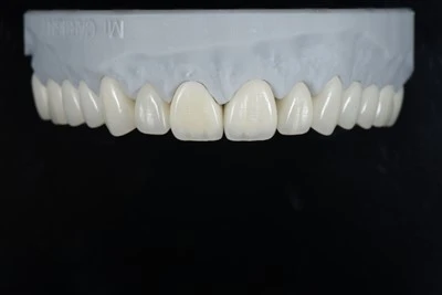 Corona E-max ad alta traslucenza